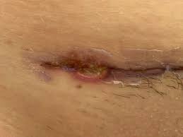 Your wound will take about 6 weeks to heal. C Section Incision Pic Included July 2020 Babies Forums What To Expect