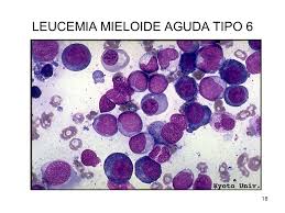 Leukemia is a cancer of the blood cells. Leucemia Mieloide Aguda Tipo 0 Ppt Download
