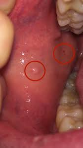 Die entzündung der ohrspeicheldrüse (eitrige parotitis) kann unterschiedliche ursachen haben. Was Ist Das An Meiner Wange Innenseite Gesundheit Arzt Zahnarzt
