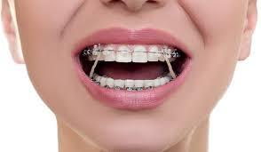 Then, after many years, the blessed day came when your train tracks were derailed. Do I Have To Wear Elastics Tony Weir Orthodontics
