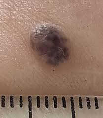 When to Worry About a Mole: 12 Red Flags | ScanSkinAI