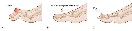 With claw toe, an individual's toes are bent into a exercises for curled toes. Hammer Toe Orthoinfo Aaos
