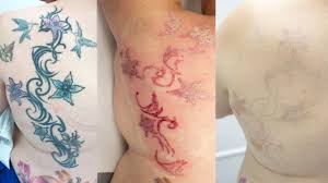 The colors used and how deep the ink is embedded are two major considerations. Laser Tattoo Removal Full Process Youtube