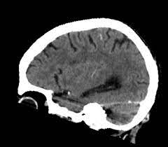 Meningeom Gutartiger Hirntumor Symptome Und Behandlung