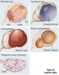 Most ovarian cysts are harmless. Cysts Guide Causes Symptoms And Treatment Options