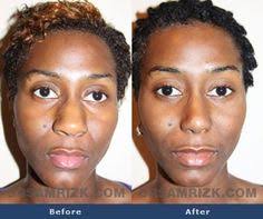 54 Before & After: Rhinoplasty ideas
