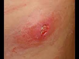 Da viele patienten, die in klinischer behandlung waren, träger von mrsa sind, ohne es zu wissen oder die entsprechenden symptome zu zeigen, sollte das rettungsfachpersonal die anamnese auch auf solche krankheiten hin betreiben. So Identifizieren Symptome Von Mrsa Youtube
