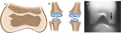 Ments when the shoulder joint is at full flexion. Developmental Disorders Of The Knee Springerlink