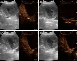 Liver failure is the final stage. Contrast Enhanced Ultrasound Features Of Malignant Focal Liver Masses In Dogs Scientific Reports