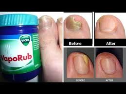 Youtube Toenail Fungus Home Remedies Nail Fungus Remedy Toenail Fungus Remedies