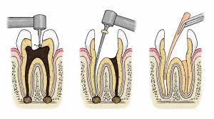 7 Important Questions About The Root Canal Procedure Webdento