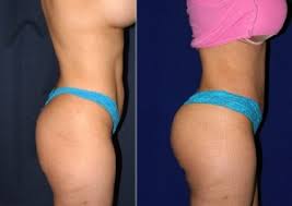 Chirurgie esthétique ou chirurgie réparatrice. Lipofilling Fessier Tunisie Prix Pas Cher Pour Une Augmentation Fesses