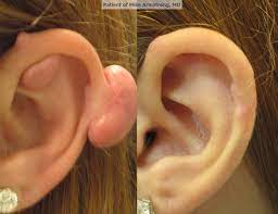 Scars And Torn Earlobes Richmond Facial Plastics