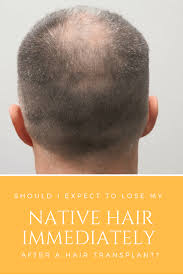 A Perfectly Conducted Hair Transplant Is The Best Solution For Most Of The Hair Loss Concerns If Hair Transplant Hair Transplant Procedure Baldness Solutions