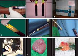 Prf membrane sutured over the graft. View Image
