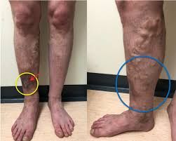 Maybe you would like to learn more about one of these? Varicose Veins In Primary Care The Bmj
