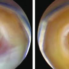 A gentle rotating action in a vertical direction was used to allow the bladeless tip to separate the tissues. 2 Palmer S Point Location Download Scientific Diagram