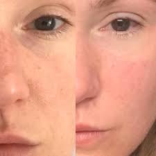 Monat skincare results after 2 years