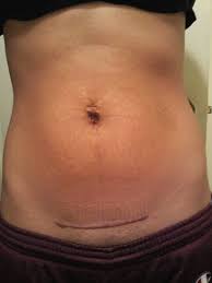Mini Tummy Tuck For Stretch Marks And Piercing Scar