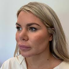 Myngoc Jennifer Ho, Pa-C | Let'S Talk About Lip Filler Migration 👄 💉Do  You Have Lip Filler Migration? I Can Help! I Specialize In A Technique To  Dissolve Only The… | Instagram