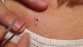 How should i treat it? Ingrown Hair Removal On Labia Pimple Popping Videos