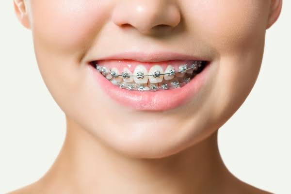 Tại sao cần hoàn tất quá trình niềng răng?