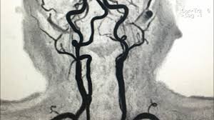 Ilacli Karotis Mr Anjio Nasil Cekilir 3d Incelemesi Nasil Yapilir Mr Emar Nasil Cekilir Siemens Youtube