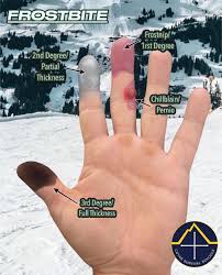 Image result for Frostbite