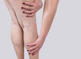Symptome dieser thrombose sind, dass das betroffene gewebe kalt und blass wirkt. Thrombose Symptome Richtig Thrombose Anzeichen Erkennen