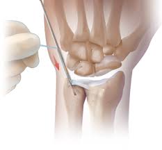 The tfcc is located at the ulnar wrist, articulating with the head of the ulna proximally and the the gold standard for assessing the integrity of the tfcc is arthroscopy. Arthrex Arthroscopic Knotless Tfcc Repair Using The Pushlock Anchor
