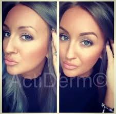 ActiDerm with Kerry Gibbons