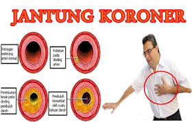 Image result for jantung koroner