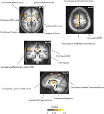 The Role Of Circulating Sex Hormones In Menstrual Cycle Dependent Modulation Of Pain Related Brain Activation Abstract Europe Pmc
