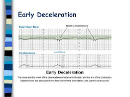 Image result for Early Deceleration