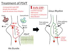 Paroxysmal supraventricular tachycardia (psvt) is episodes of rapid heart rate that start in a part of the heart above the ventricles. Psvt