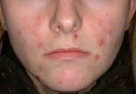 For allergic reaction hives, it only takes a change of diet, changing or removing medications, and treatment of infections to get rid of hives completely. How To S Wiki 88 How To Get Rid Of Hives On Face