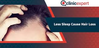 Help support us from as. Less Sleep Cause Hair Loss Clinicexpert International Hair Transplant Plastic Surgery