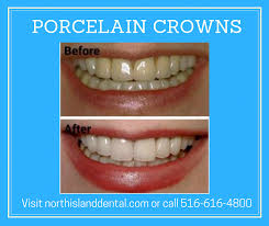 Mixed Dental Crowns Before And After Fit Dentisttime Dentalcrownproducts Dental Crowns Dental Cosmetics Dental
