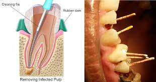Pencabutan gigi bungsu (geraham terakhir) yang bermasalah atau tidak tumbuh sempurna rutin dilakukan, begitu juga pencabutan beberapa gigi perawatan endodontik atau biasa disebut dengan perawatan saluran akar diperlukan apabila infeksi pada gigi sudah meluas ke saluran akar. Rawatan Akar Gigi Murah