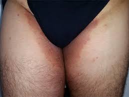 In cele mai multe cazuri, barbatii sunt asimptomatici, asadar nu vor sti ca au contractat o infectie genitala. Intertrigo Ce Este Si Cum Se Trateaza Dr Mihai Lupu