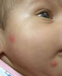 We did not find results for: My 2 5 Month Baby Is Having These Red Pimple Sort Of Marks On Face And 1 On Eyel