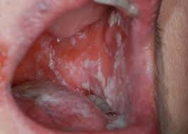 Image result for Oral thrush roof of mouth