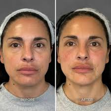 Albuquerque Full Face Balancing Before & After: Chrome Aesthetics