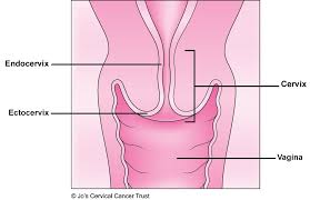 The cancer is linked to a virus that is spread during sexual. About The Cervix Information Jo S Cervical Cancer Trust