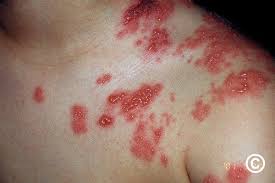 Image result for shingles in children