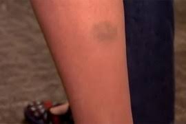 Nanesite led na oko 15 minuta, i uvek stavite nešto poput peškira ili krpe između leda i vaše kože. Ako Imate Neobjasnjive Modrice Po Tijelu To Moze Biti Znak Za Uzbunu