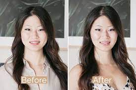 Patients have reported improvements in their tmj pain after botox® treatments. Thenotice Jaw Pain Medical Botox For Tmd Experience Review