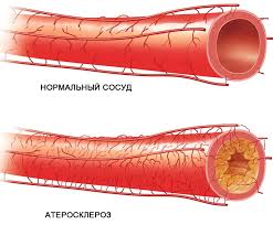 Результат пошуку зображень за запитом "атеросклероз венечных артерий"