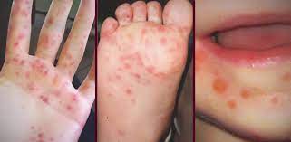 Se transmite foarte usor de la copil la copil, pe cale orala, prin secretiile nazofaringiene, tuse, stranut si prin contactul direct. Sanatate Boala Numita Gura Mana Picior Extrem De Contagioasa A Afectat In Ultima Luna Peste 30 De Copii Suceveni Monitorul De Suceava Joi 4 Iulie 2019