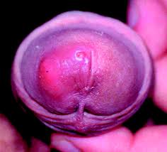 Reddit, a couple years ago I got a mosquito bite on my penis. It itched  terribly for days, but the full story is so much worse than that... : rWTF